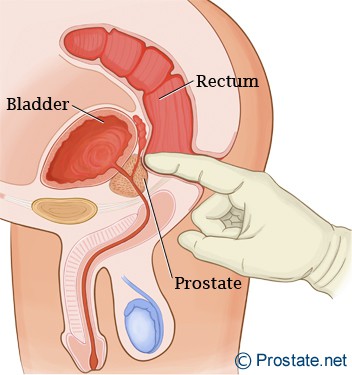http://www.prostate.net/wp-content/uploads/2010/08/prostate-rectal-exam.jpg