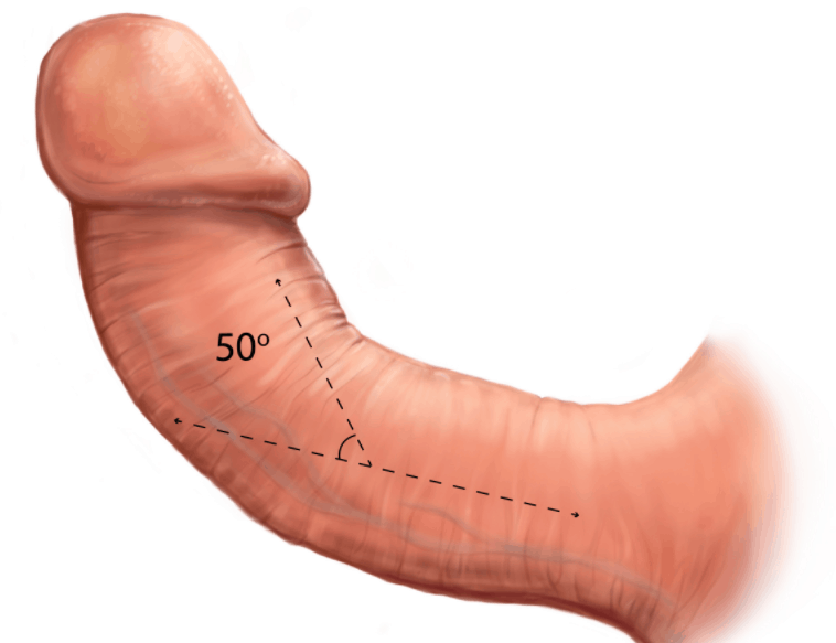 peyronies disease pictures curve in penis