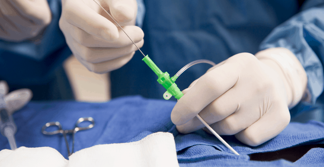 device insertion/catheter