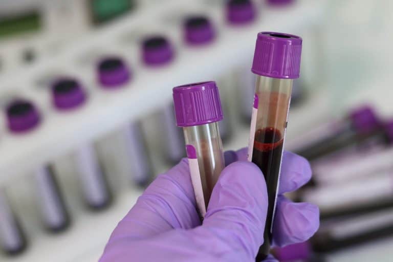 New Blood Test for Aggressive Prostate Cancer